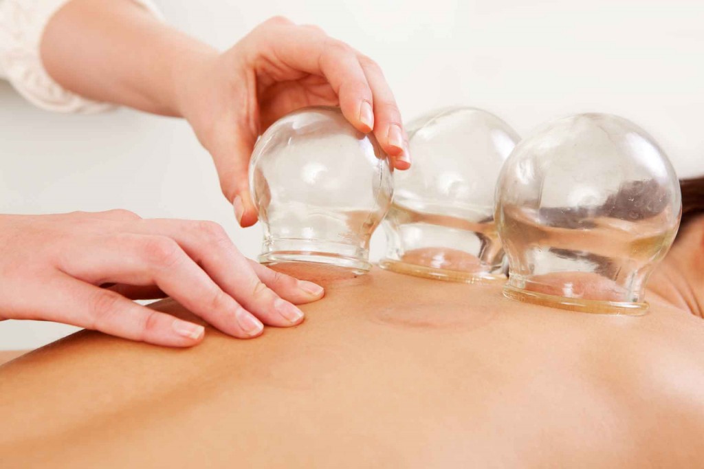 Cupping Treament