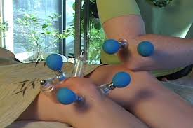 orthopaedic-1-cupping