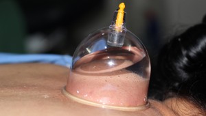 water cupping